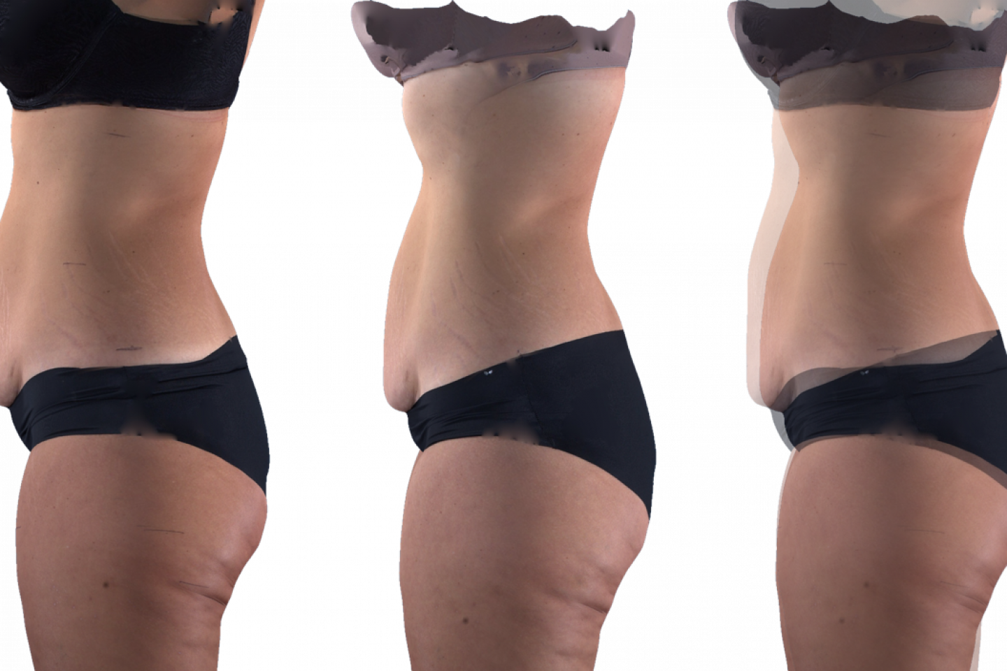 body contouring in Longview,TX